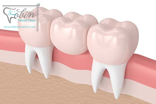 بریج دندان چیست و چه کاربردی دارد؟